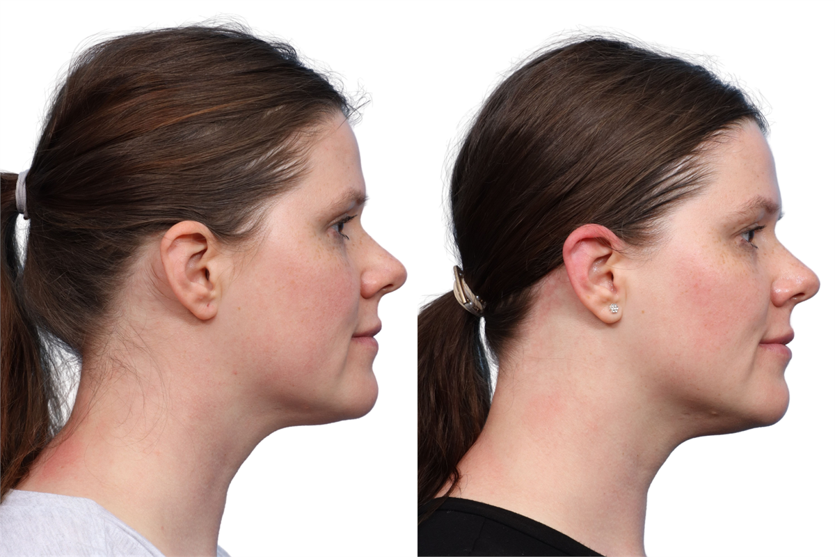 XERF Before & After Gallery - Patient 709492 - Image 5