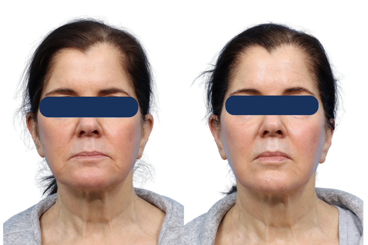 XERF Before & After Gallery - Patient 606035 - Image 1