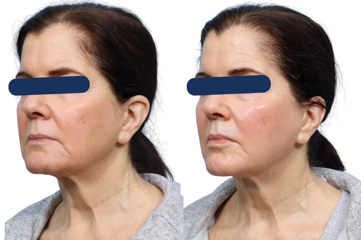 XERF Before & After Gallery - Patient 606035 - Image 2