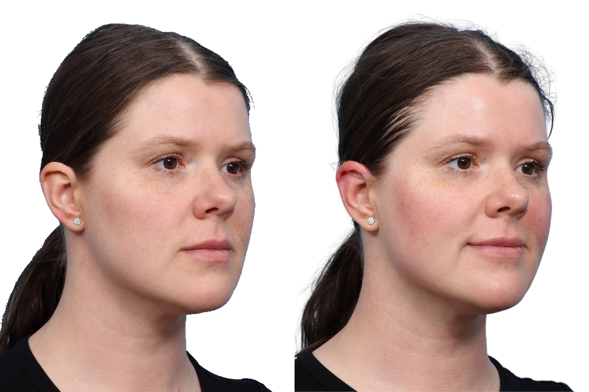 XERF Before & After Gallery - Patient 709492 - Image 1
