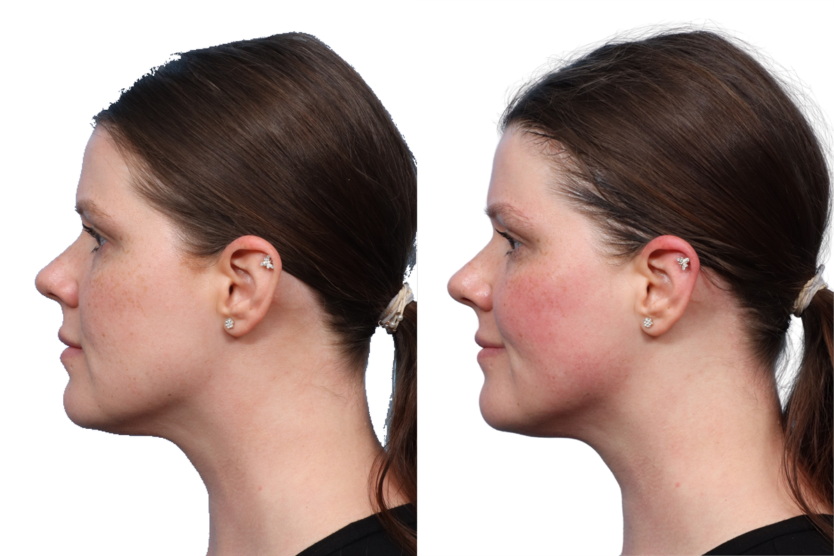 XERF Before & After Gallery - Patient 709492 - Image 2