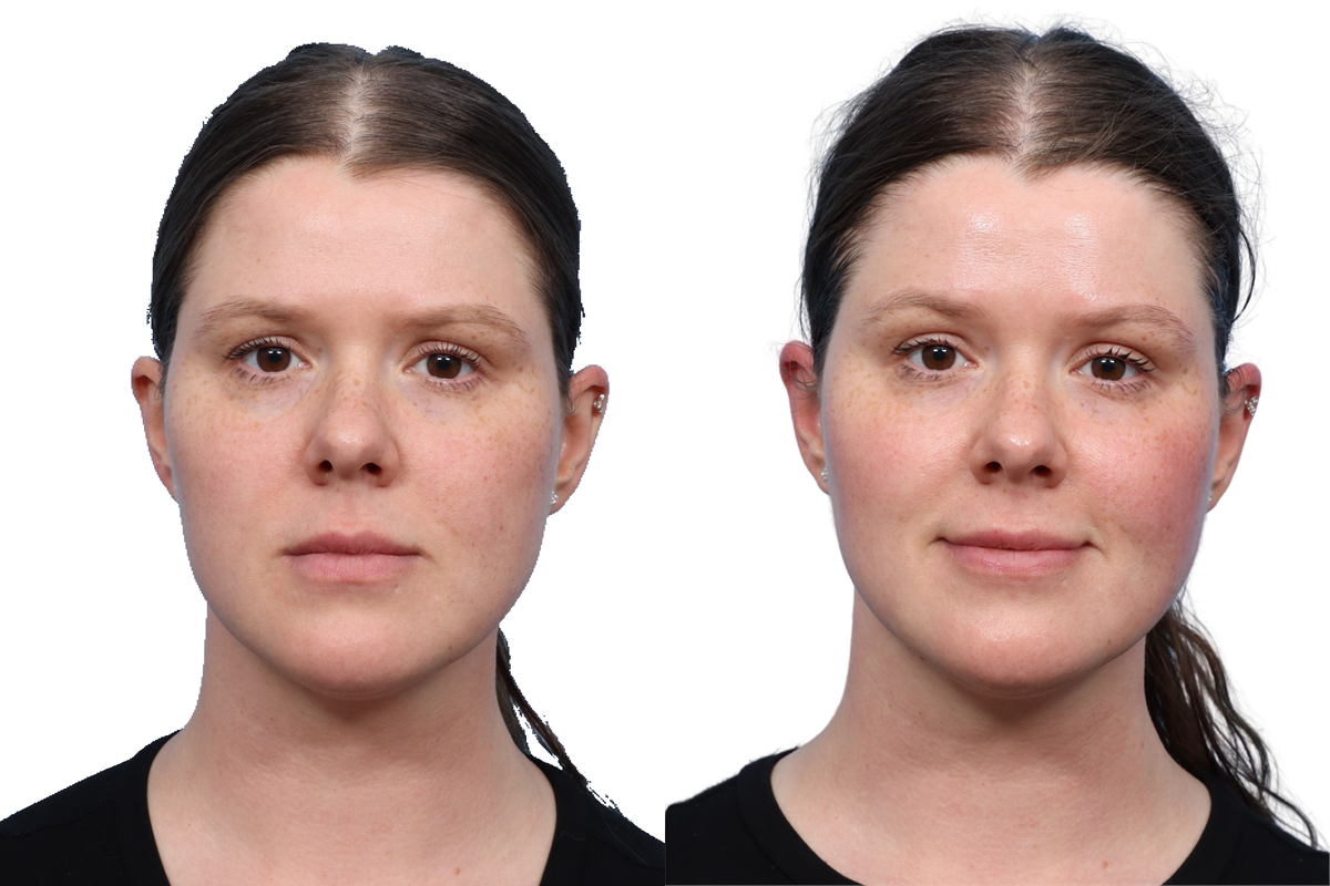 XERF Before & After Gallery - Patient 709492 - Image 3