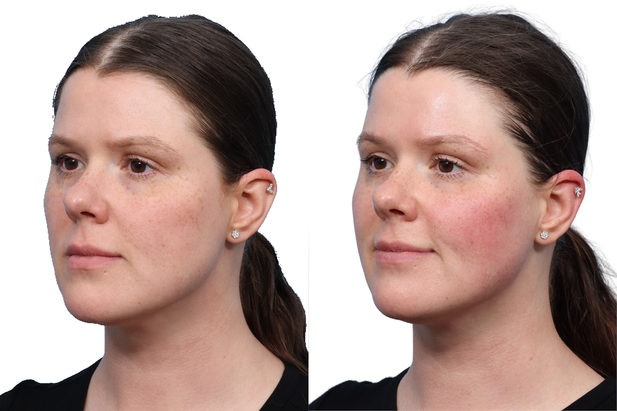 XERF Before & After Gallery - Patient 709492 - Image 4