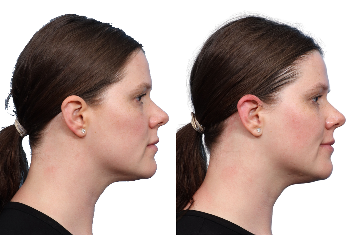 XERF Before & After Gallery - Patient 709492 - Image 5