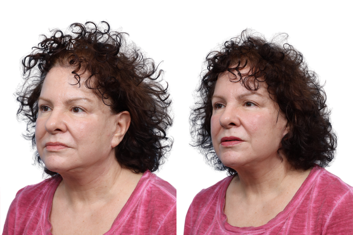 XERF Before & After Gallery - Patient 801438 - Image 1