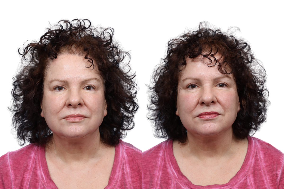 XERF Before & After Gallery - Patient 801438 - Image 2
