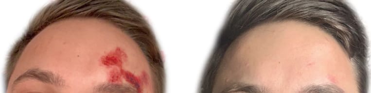 Picoway® Before & After Gallery - Patient 344397 - Image 1