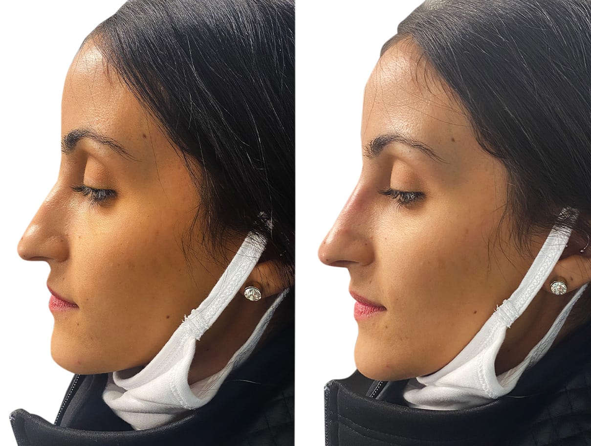 Non-Surgical Rhinoplasty Before & After Gallery - Patient 131897 - Image 1