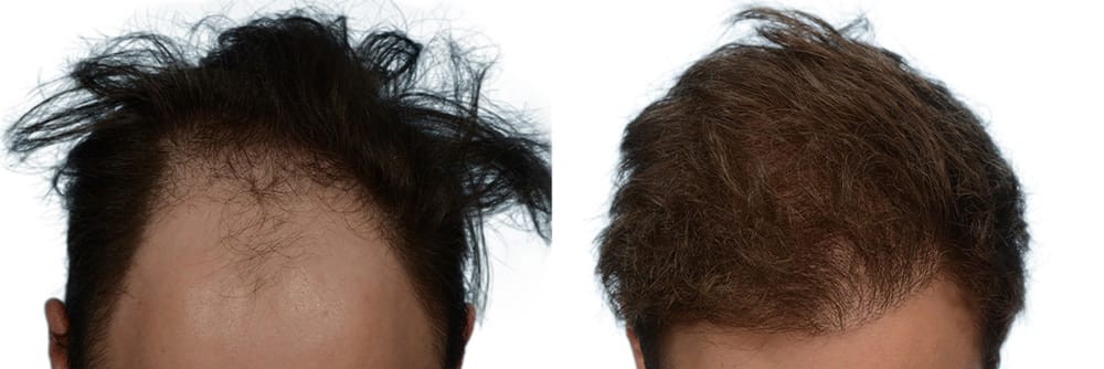 Hair Restoration Before & After Gallery - Patient 275791 - Image 1
