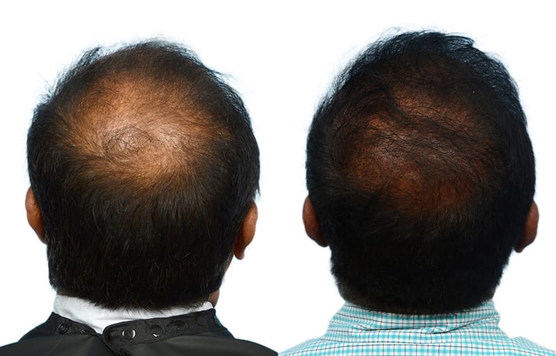 Hair Restoration Before & After Gallery - Patient 158622 - Image 1