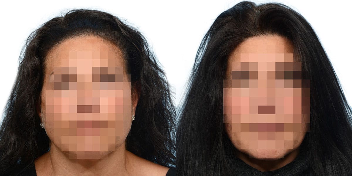 Hair Restoration Before & After Gallery - Patient 392065 - Image 1