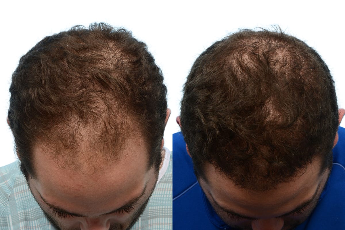 Hair Restoration Before & After Gallery - Patient 376745 - Image 1