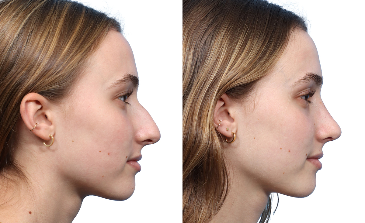 woman's rhinoplasty results