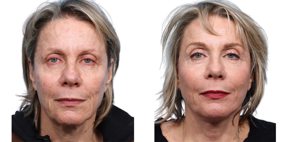 CO2 Laser Before & After Gallery - Patient 273859 - Image 3