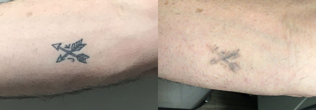Tattoo Removal Before & After Gallery - Patient 257710 - Image 1