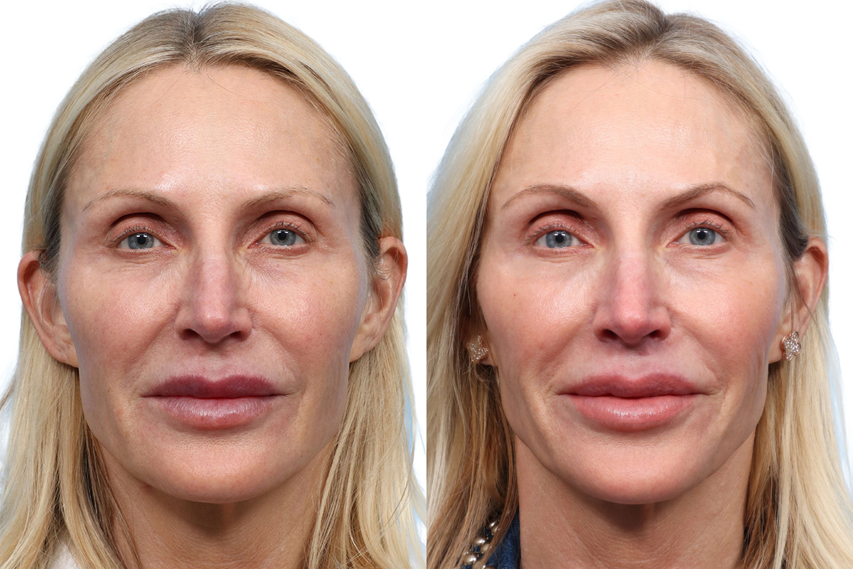 Sculptra Before & After Gallery - Patient 215066 - Image 1