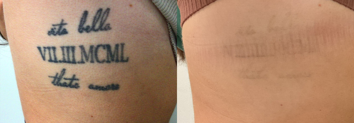Tattoo Removal Before & After Gallery - Patient 137907 - Image 1