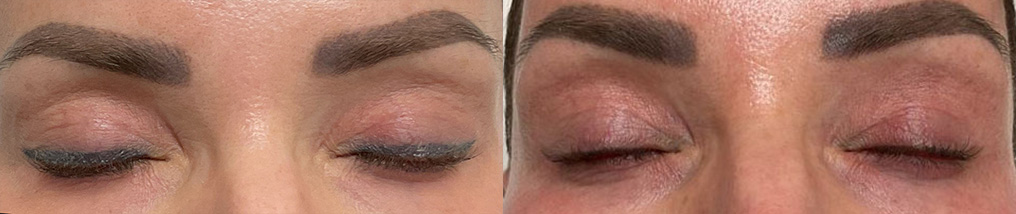 Tattoo Removal Before & After Gallery - Patient 276127 - Image 1