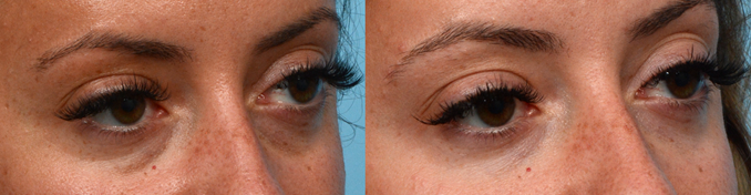 Tear Trough Filler Before & After Gallery - Patient 256284 - Image 2