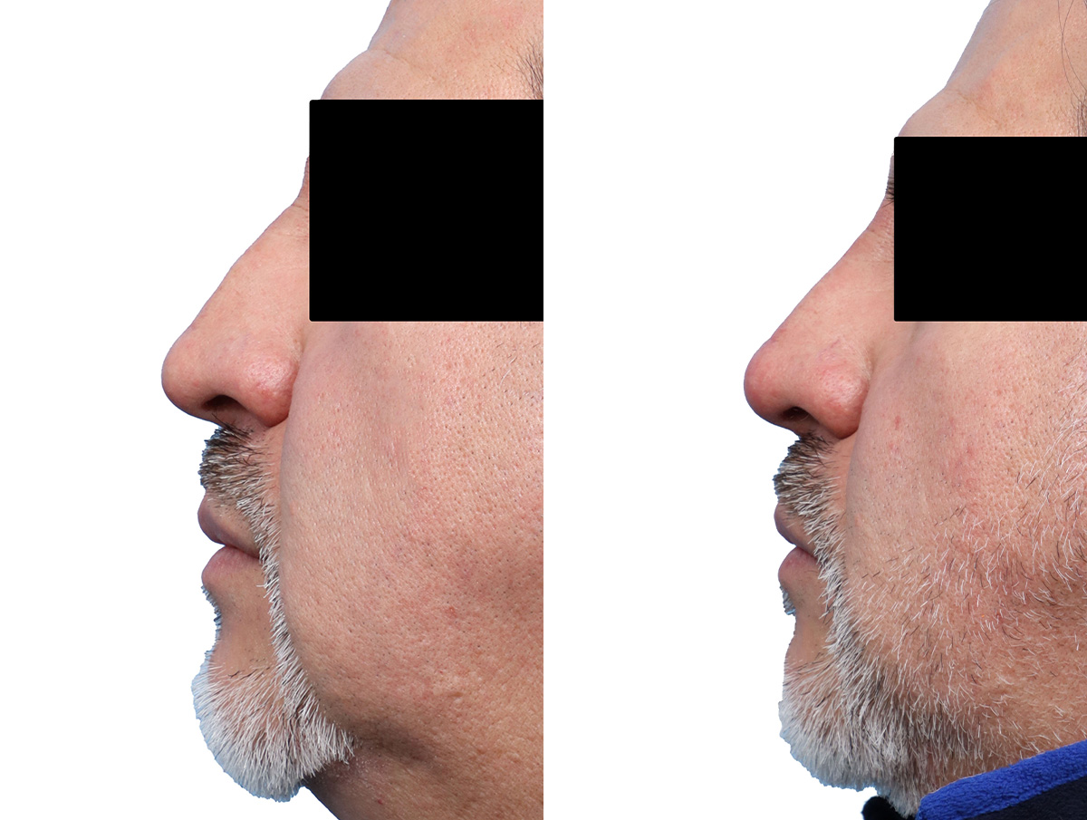 Non-Surgical Rhinoplasty Before & After Gallery - Patient 189267 - Image 2