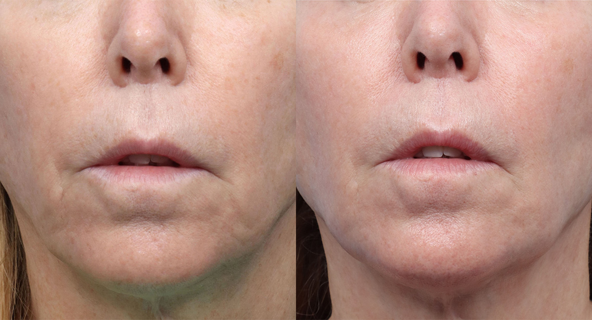 Cool Peel Before & After Gallery - Patient 202993 - Image 1