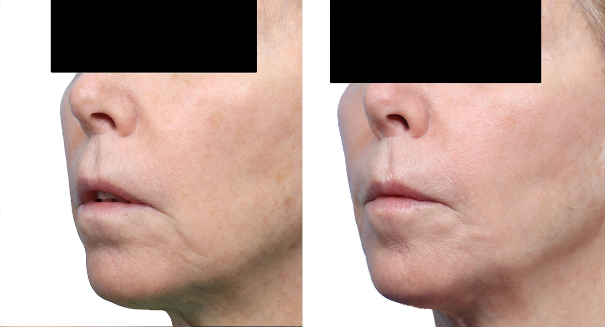 Cool Peel Before & After Gallery - Patient 202993 - Image 3