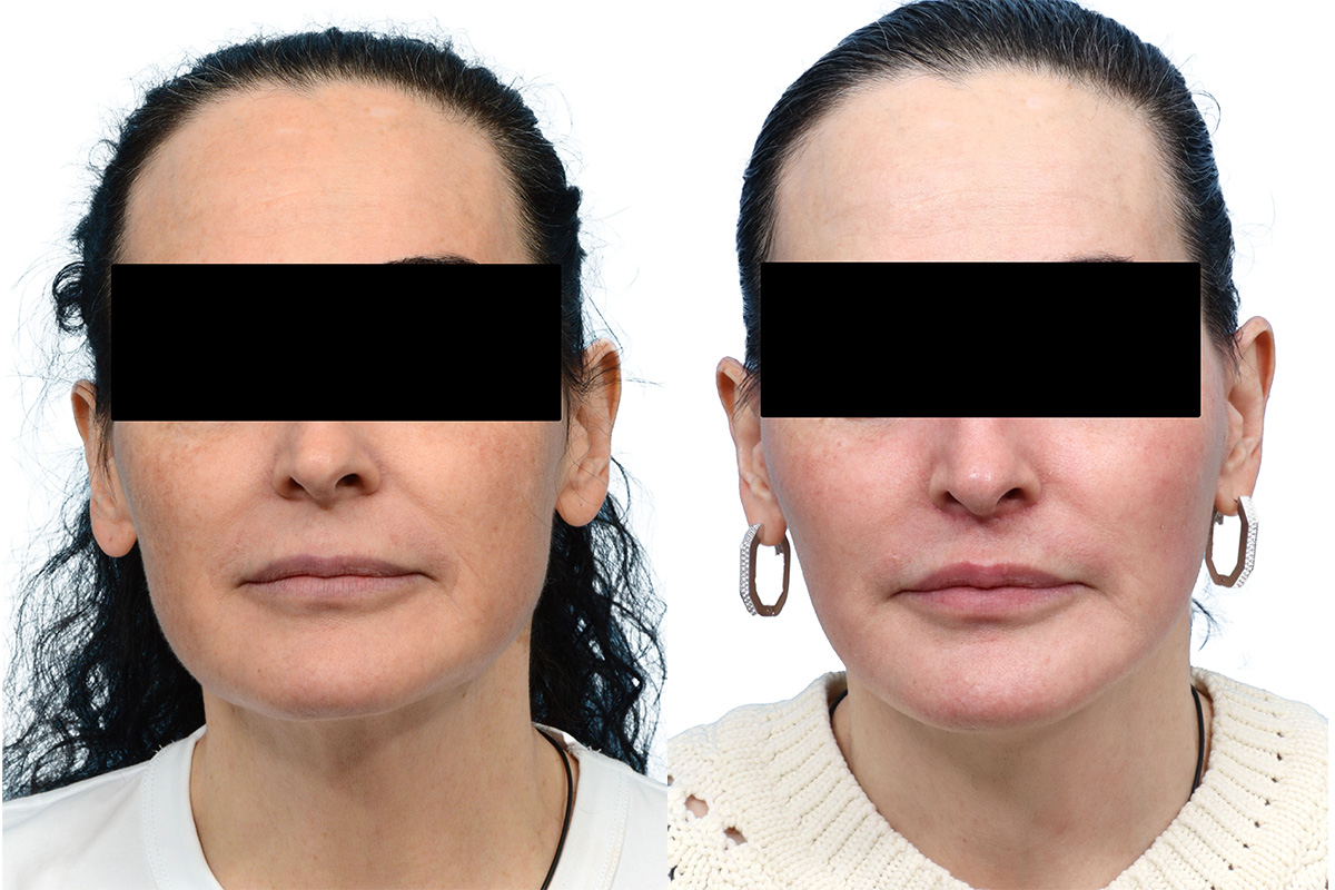 CO2 Laser Before & After Gallery - Patient 162674 - Image 1