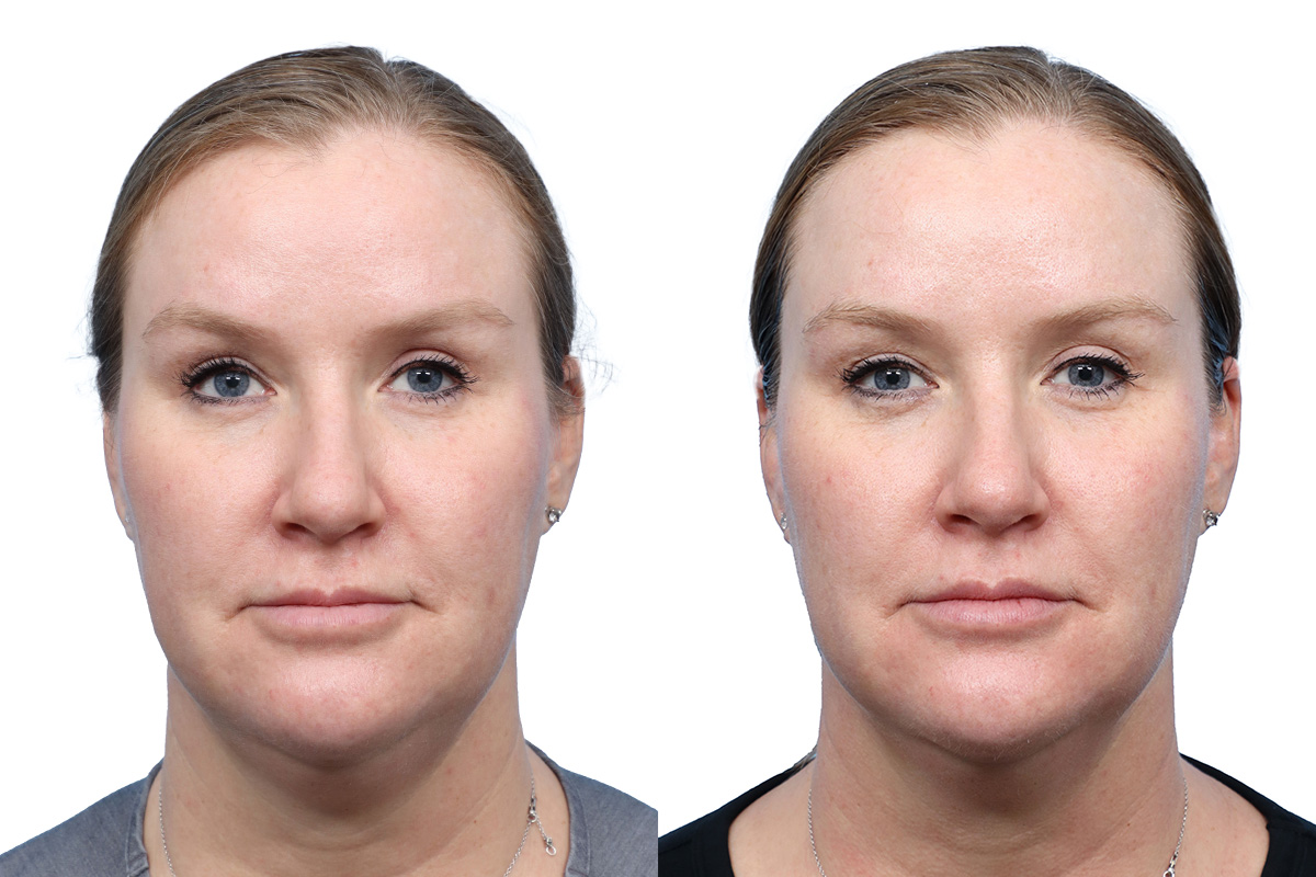 Glacial Skin Rx Before & After Gallery - Patient 354819 - Image 1