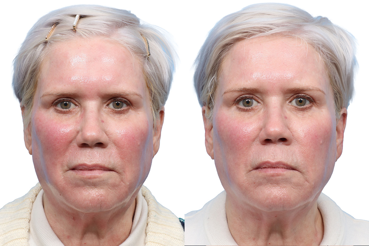 Glacial Skin Rx Before & After Gallery - Patient 281877 - Image 1