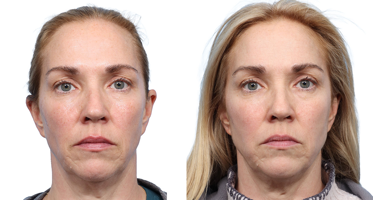 Picoway® Before & After Gallery - Patient 161342 - Image 1