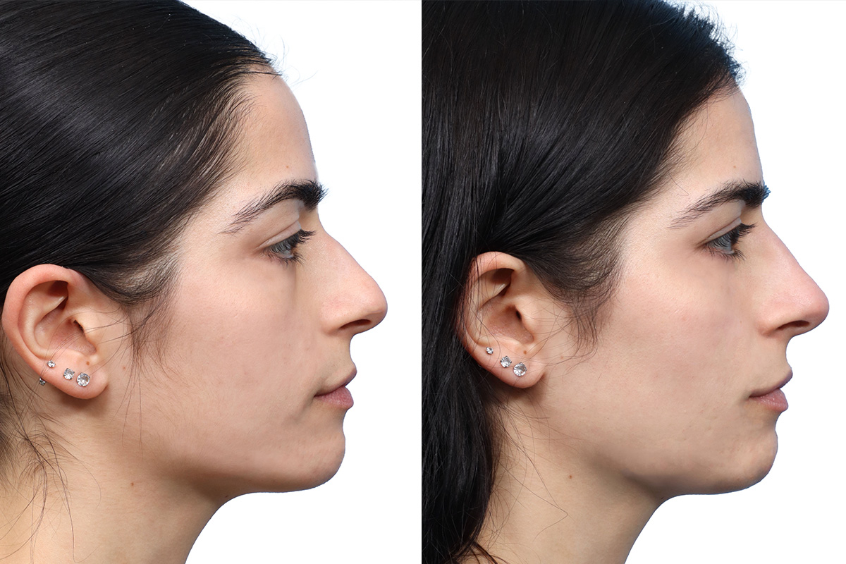 Non-Surgical Rhinoplasty Before & After Gallery - Patient 267926 - Image 1