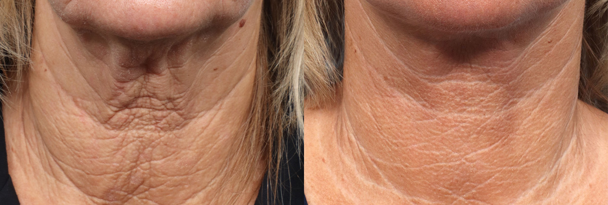 CO2 Laser Before & After Gallery - Patient 231200 - Image 1