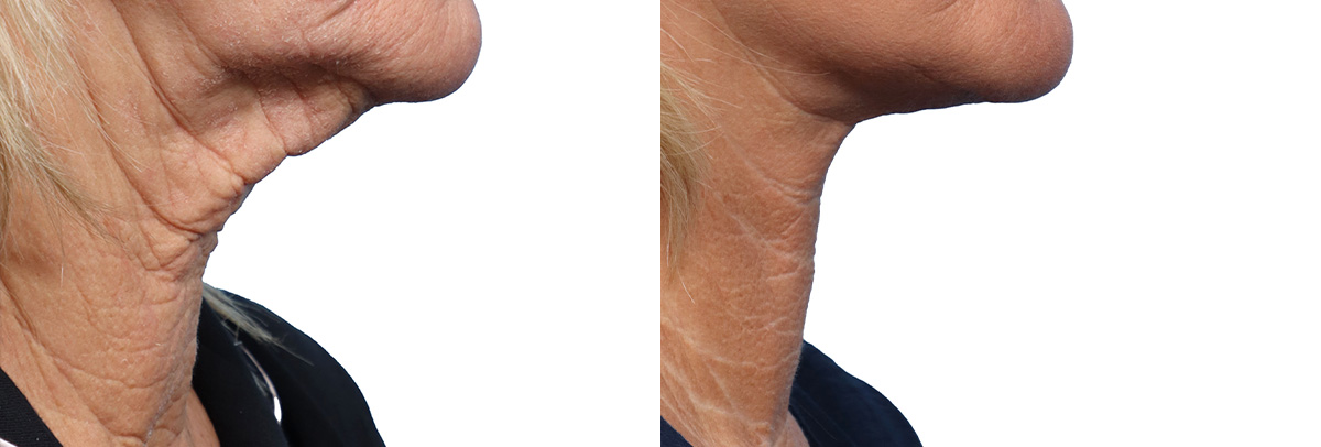 CO2 Laser Before & After Gallery - Patient 231200 - Image 2