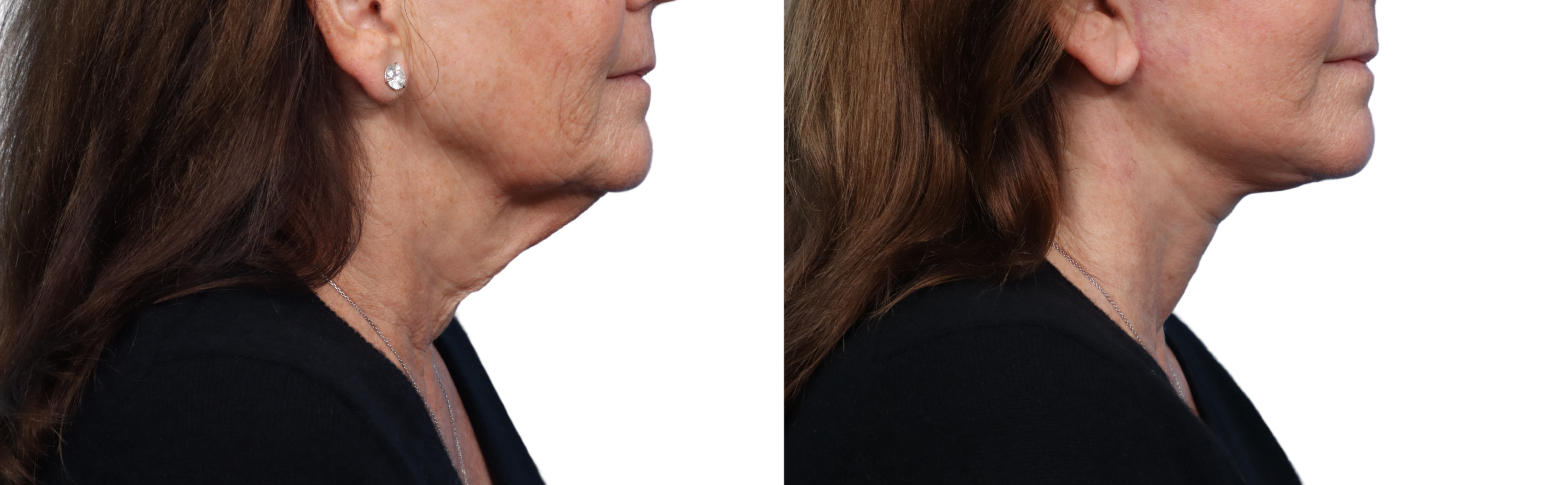 CO2 Laser Before & After Gallery - Patient 384191 - Image 3
